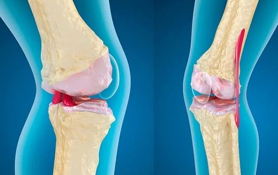 Gonarthrosis of the 3rd degree of knee joint