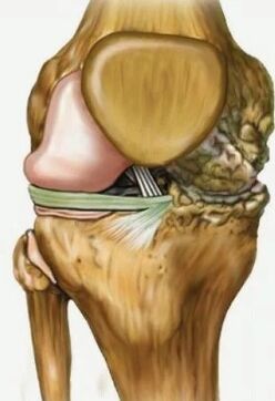 Knee arthrosis