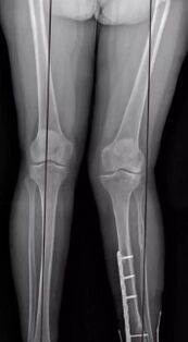 Knee deformation