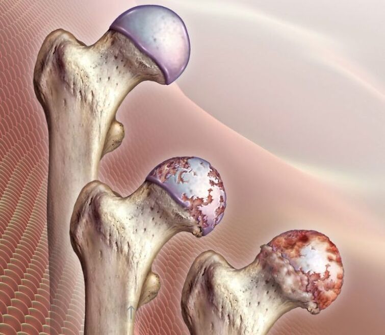 Hip arthrosis