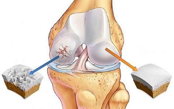 Norm and deviation for knee arthrosis joint
