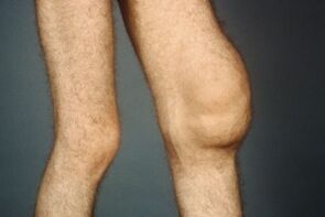 The causes and symptoms of knee arthrosis joint