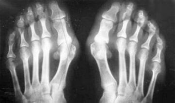 Differential diagnosis of symptoms of arthritis and arthrosis
