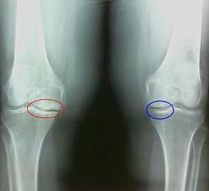 The result of the treatment of arthritis and arthrosis folk remedies