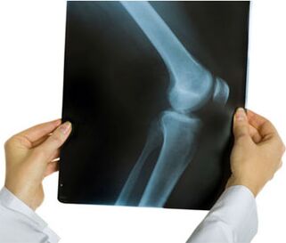X-ray picture of arthrosis of the knee joint