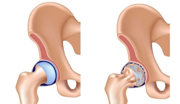 Healthy and joint with arthrosis