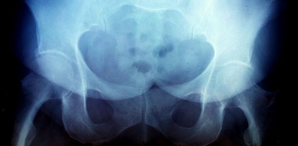 X -ray photo with arthrosis of 2 degrees